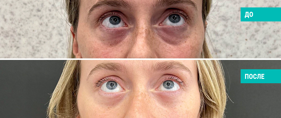 До и после нижней блефаропластики. Пластический хирург Н. Б. Иоселиани