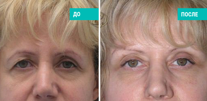 До и после круговой блефаропластики. Пластический хирург Е. С. Кудинова