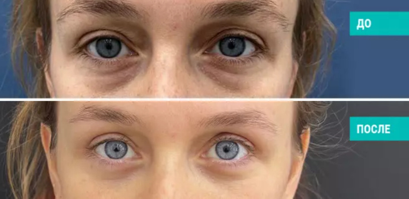 До и после круговой блефаропластики. Пластический хирург Н. Б. Иоселиани