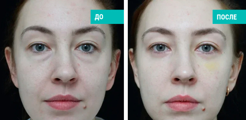 До и после нижней блефаропластики. Пластический хирург В. Э. Кобазев