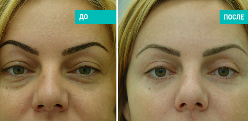 До и после нижней блефаропластики. Пластический хирург В. Г. Якимец
