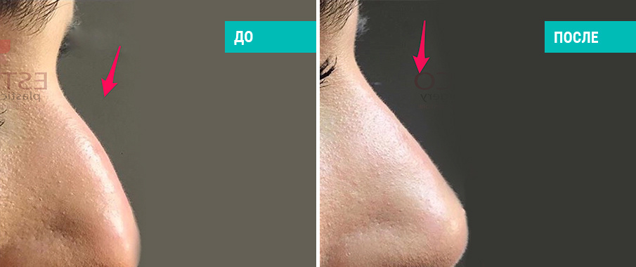 До и после контурной пластики носа. Косметолог Стамболцян Е. В.