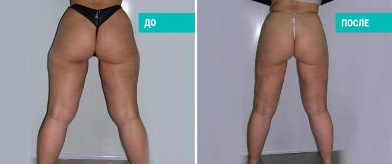 До и после липосакции бедер. Пластический хирург И. А. Бутко