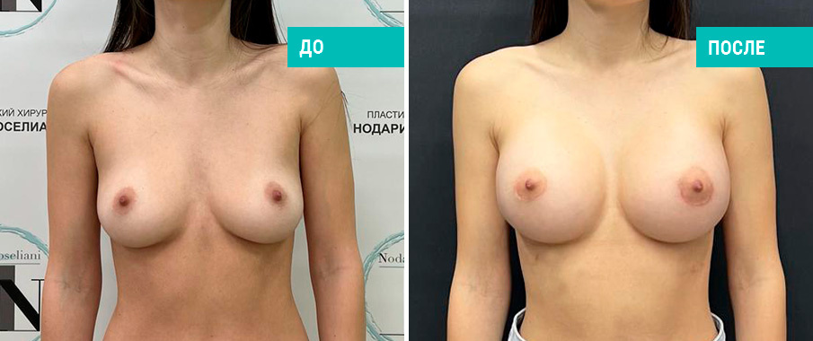 Фото до и после установки имплантов. Пациентка Н. Б. Иоселиани
