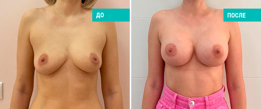 Фото до и после установки имплантов. Пациентка Н. Б. Иоселиани