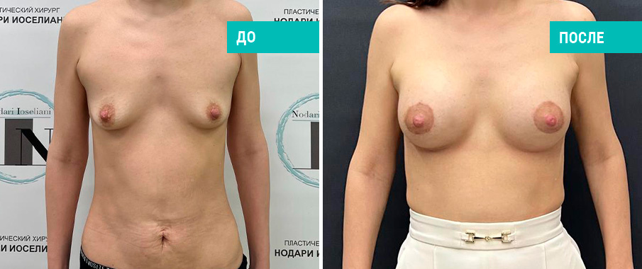 Фото до и после установки имплантов. Пациентка Н. Б. Иоселиани
