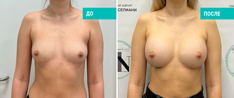 Фото до и после установки имплантов. Пациентка Н. Б. Иоселиани