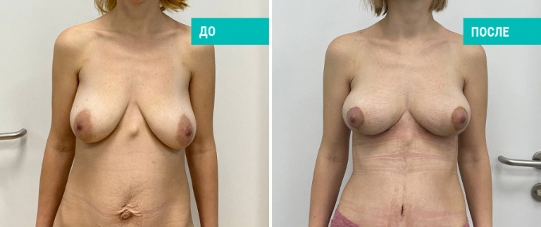 Фото до и после подтяжки груди с уменьшением. Пациентка Н. Б. Иоселиани