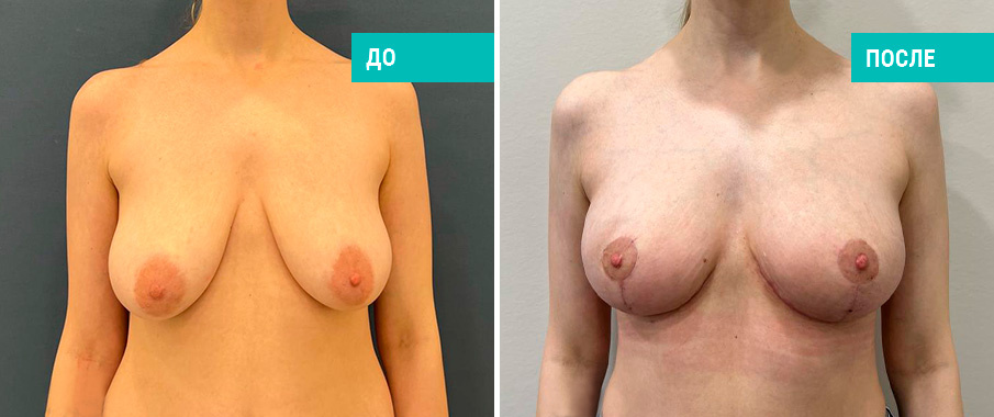 Фото до и после подтяжки груди. Пациентка Н. Б. Иоселиани