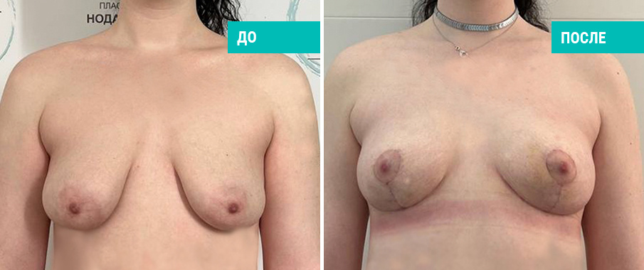 Фото до и после подтяжки тубулярной груди. Пациентка Н. Б. Иоселиани