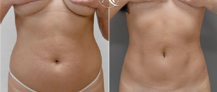 До и после липофилинга. Пластический хирург А. Н. Ковынцев