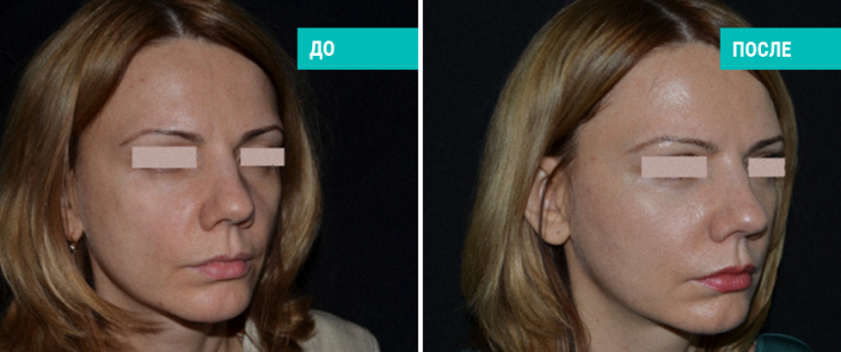 До и после липофилинга лица. Пластический хирург Д. Р. Гришкян