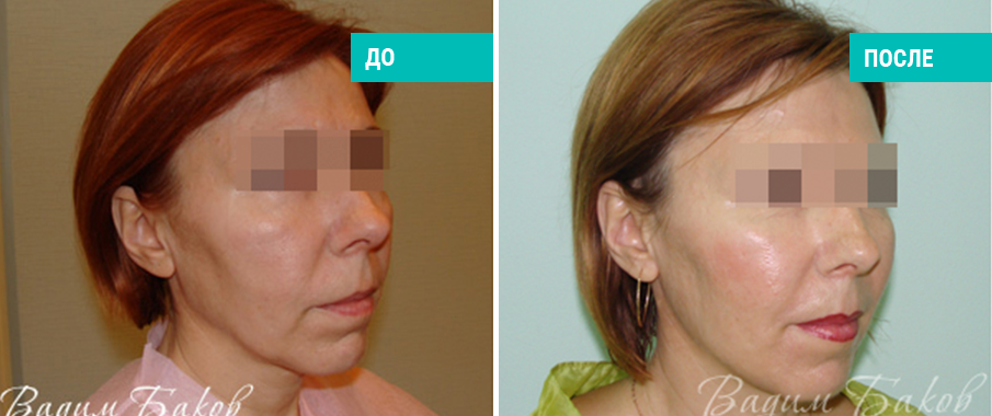 До и после нитевого лифтинга. Пластический хирург В. С. Баков