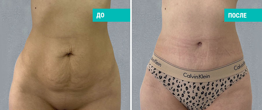 До и после пластики живота. Пластический хирург Д .А. Зимин