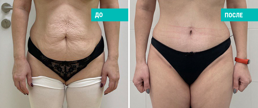До и после пластики живота. Пластический хирург Н. Б. Иоселиани