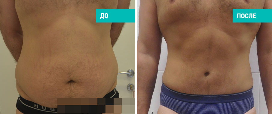 До и после пластики живота. Пластический хирург О. А. Ованесова