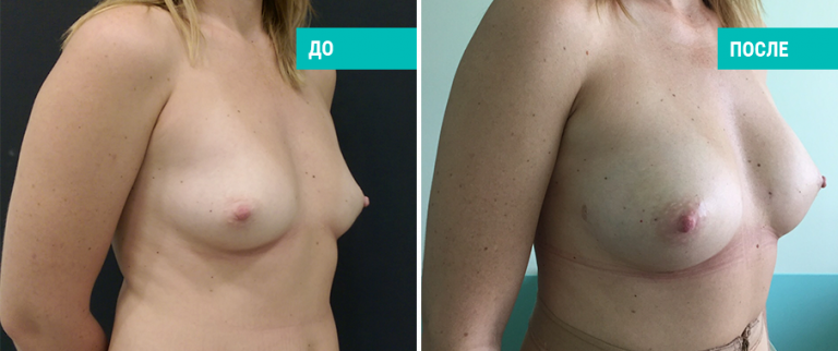 До и после липофилинга груди. Пластический хирург Е. А. Лонская