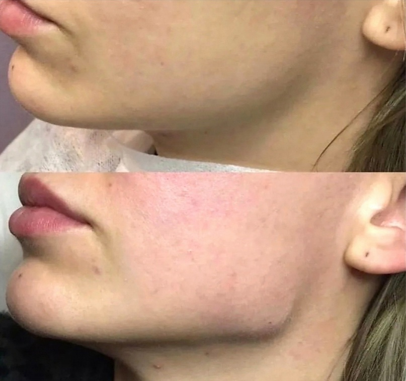 Процедура выполнена специалистами клиники омоложения Левона Чахояна