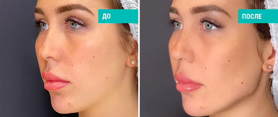 До и после контурной пластики углов челюсти. Косметолог С. А. Зубкова