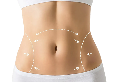 Липосакция