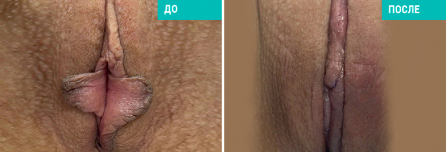 Интимная пластика