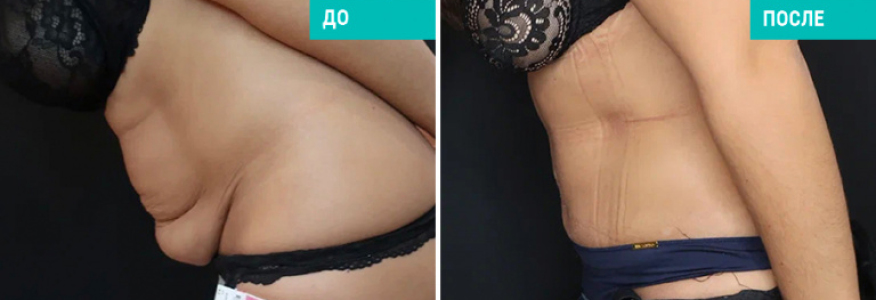 Абдоминопластика