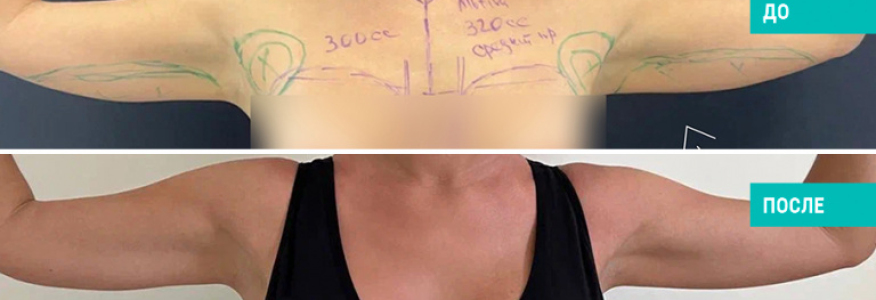 Липосакция