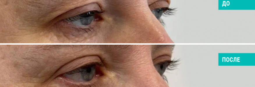 Блефаропластика