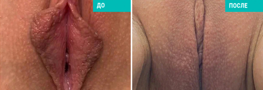 Интимная пластика