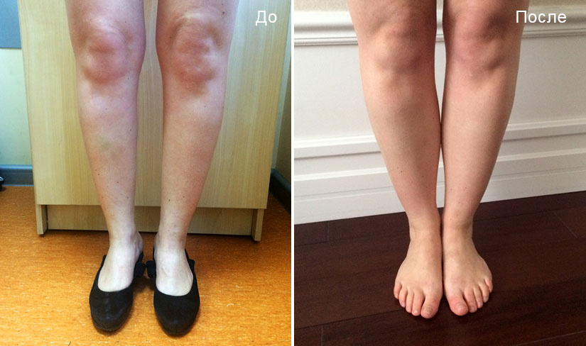До и после круропластики. Пластический хирург Д. В. Крысин