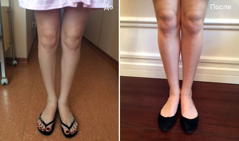 До и после круропластики. Пластический хирург Д. В. Крысин