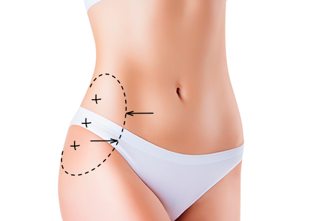 Торсопластика