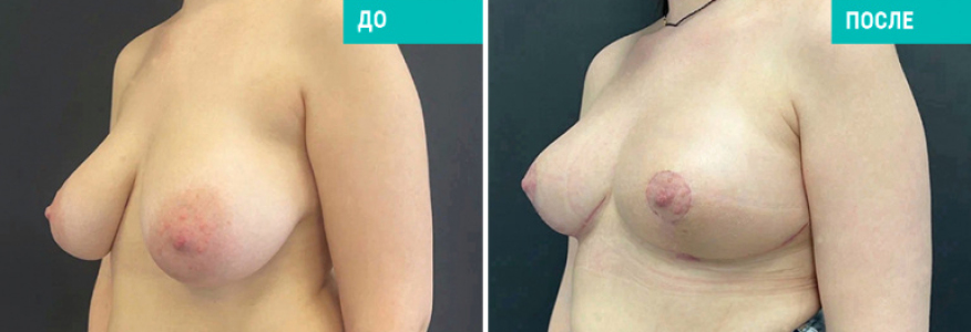 Маммопластика