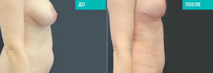 Абдоминопластика