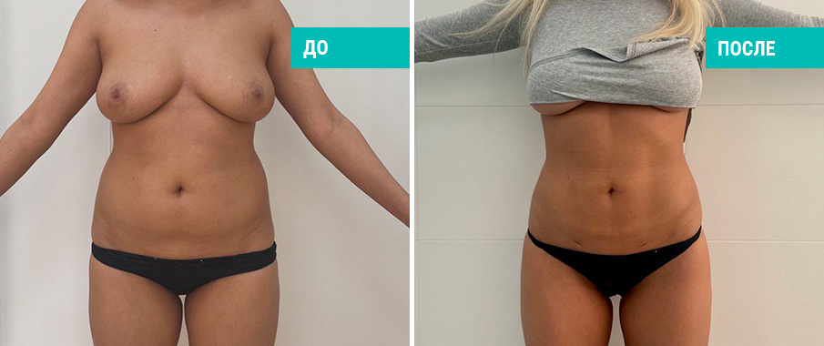 Липосакция живота и боков. Пластический хирург Н. Б. Иоселиани