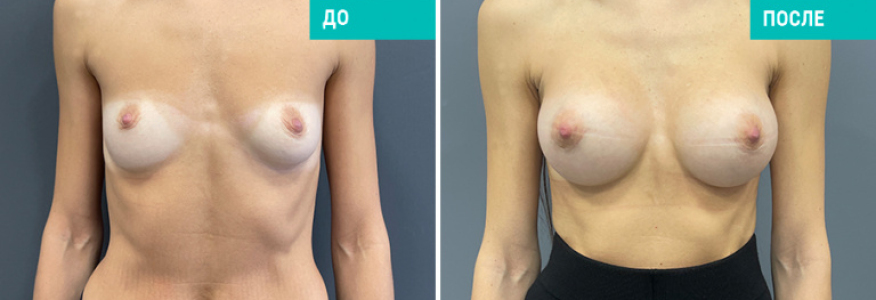 Маммопластика