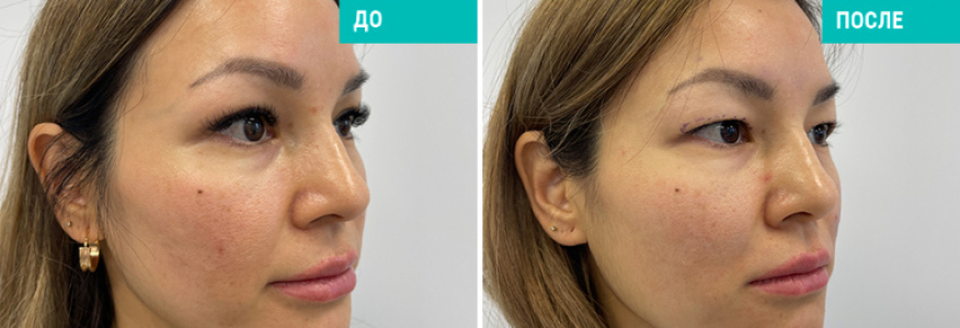 Блефаропластика