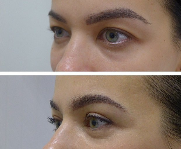 До и после блефаропластики. Пластический хирург А. А. Михайлов