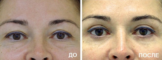 До и после круговой блефаропластики. Пластический хирург В. В. Наумов