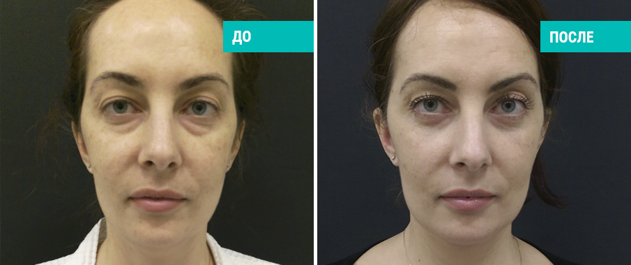 До и после блефаропластики. Пластический хирург А. Е. Кашманов