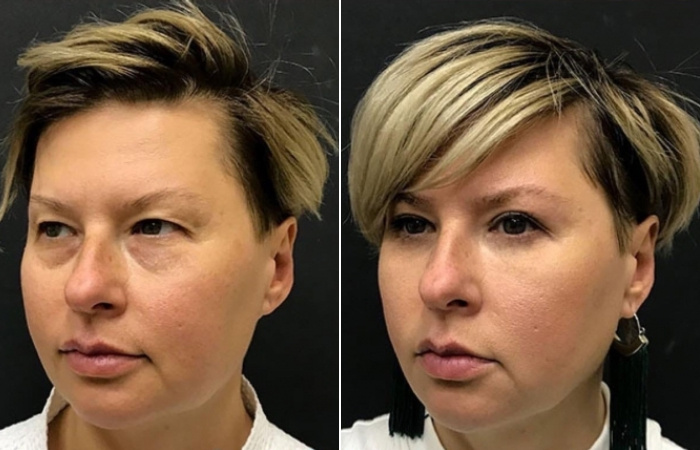 До и после блефаропластики. Пластический хирург О. А. Ованесова