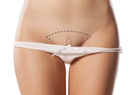 Липофилинг половых губ