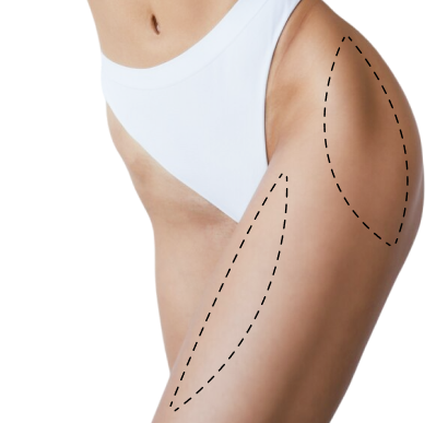 Липомоделирование тела