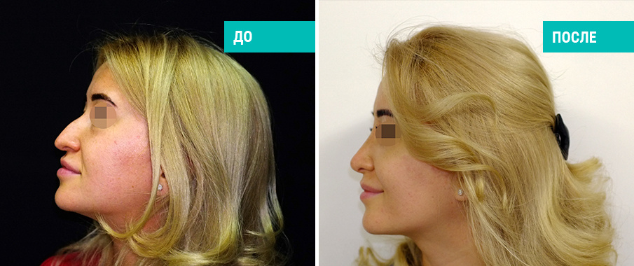 До и после ринопластики. Пластический хирург Г. П. Бабаян