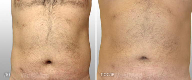 До и после липосакции. Пластический хирург И. Б. Ганьшин