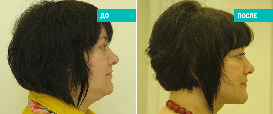 До и после липосакции подбородка. Пластический хирург Т. А. Иванченкова