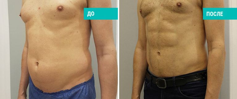 До и после Vaser-лиаосакции. Пластический хирург В. А. Зленко