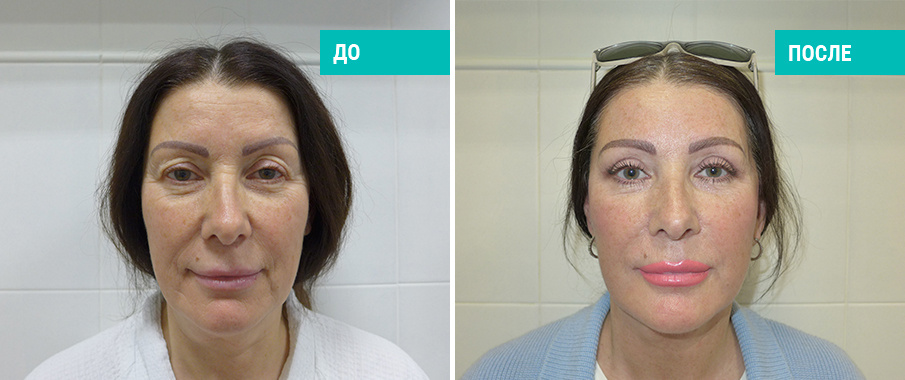 До и после комплексного омоложения лица и шеи. Пластический хирург А. А. Михайлов