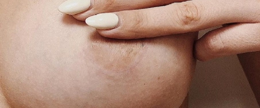 Пластический хирург М. Л. Нестеренко. Шов после периареолярного увеличения груди с установкой имплантов