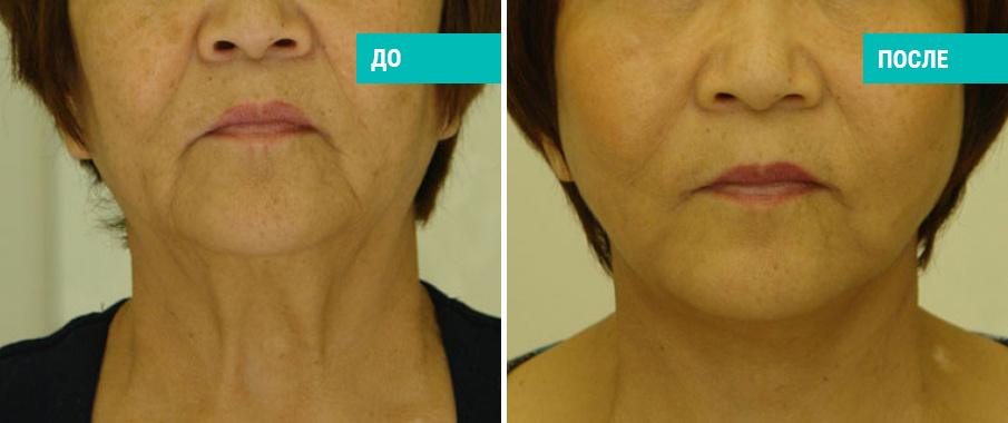 До и после подтяжки лица и шеи. Пластический хирург В. Г. Якимец